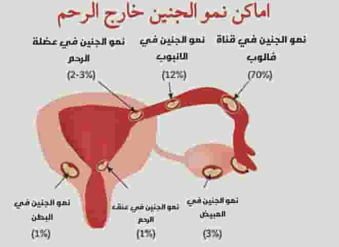 ما هو الحمل خارج الرحم ومخاطرة وكيف اكتشافة وطرق علاجه؟