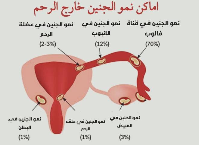 ما هو الحمل خارج الرحم ومخاطرة وكيف اكتشافة وطرق علاجه؟